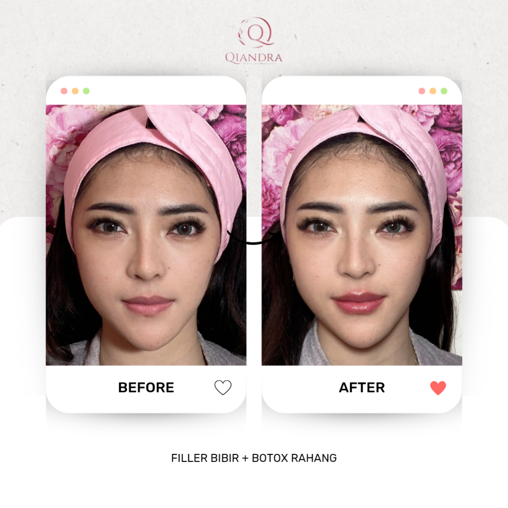 filler untuk contouring wajah