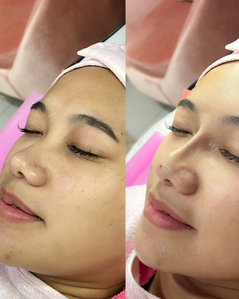 Before after Benang Hidung Qiandra Clinic