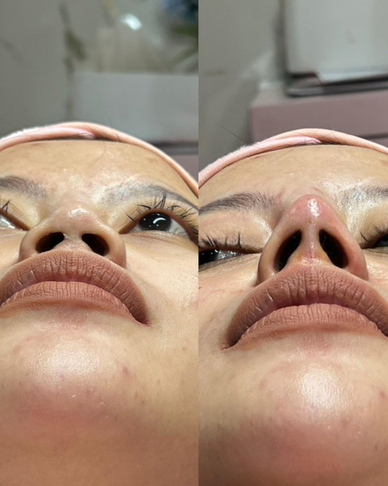 Before after Benang Hidung Qiandra Clinic