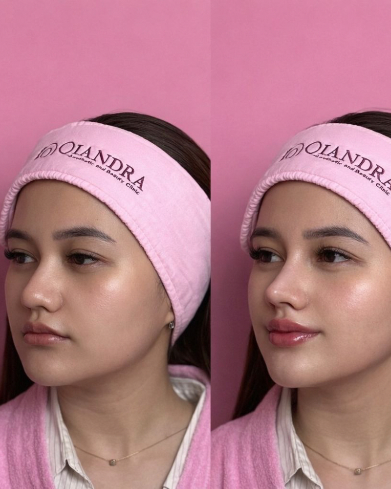 Before after Benang Hidung + Filler Bibir Qiandra Clinic