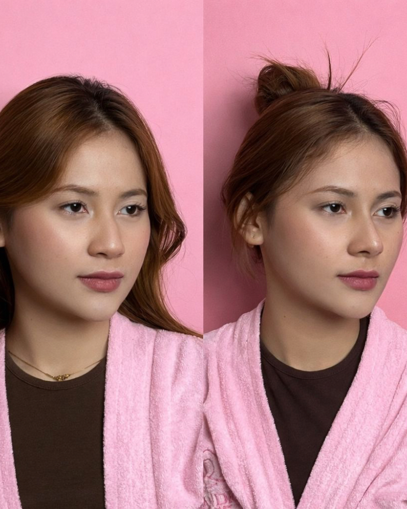 Before after Benang Hidung Qiandra Clinic