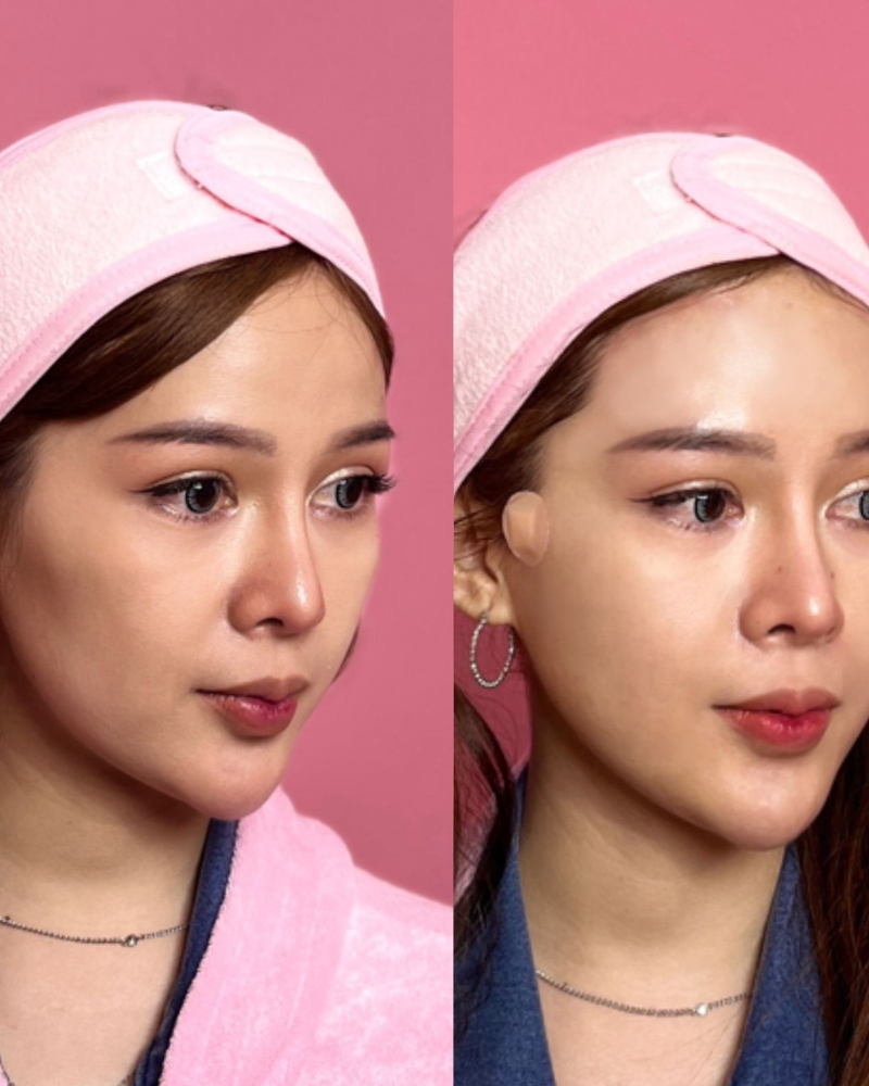 Before after Benang VXIL Qiandra Clinic