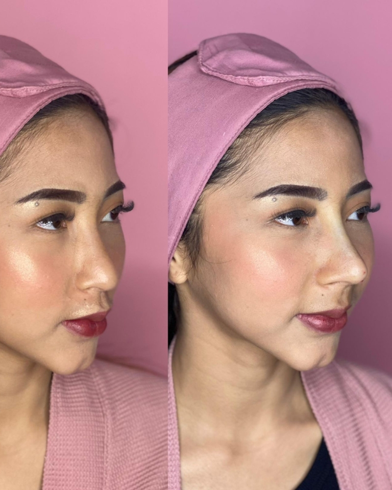 Before after New Cleopatra Nose Qiandra Clinic