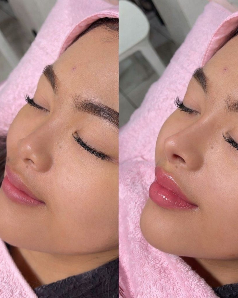Before after Doll Nose Qiandra Clinic