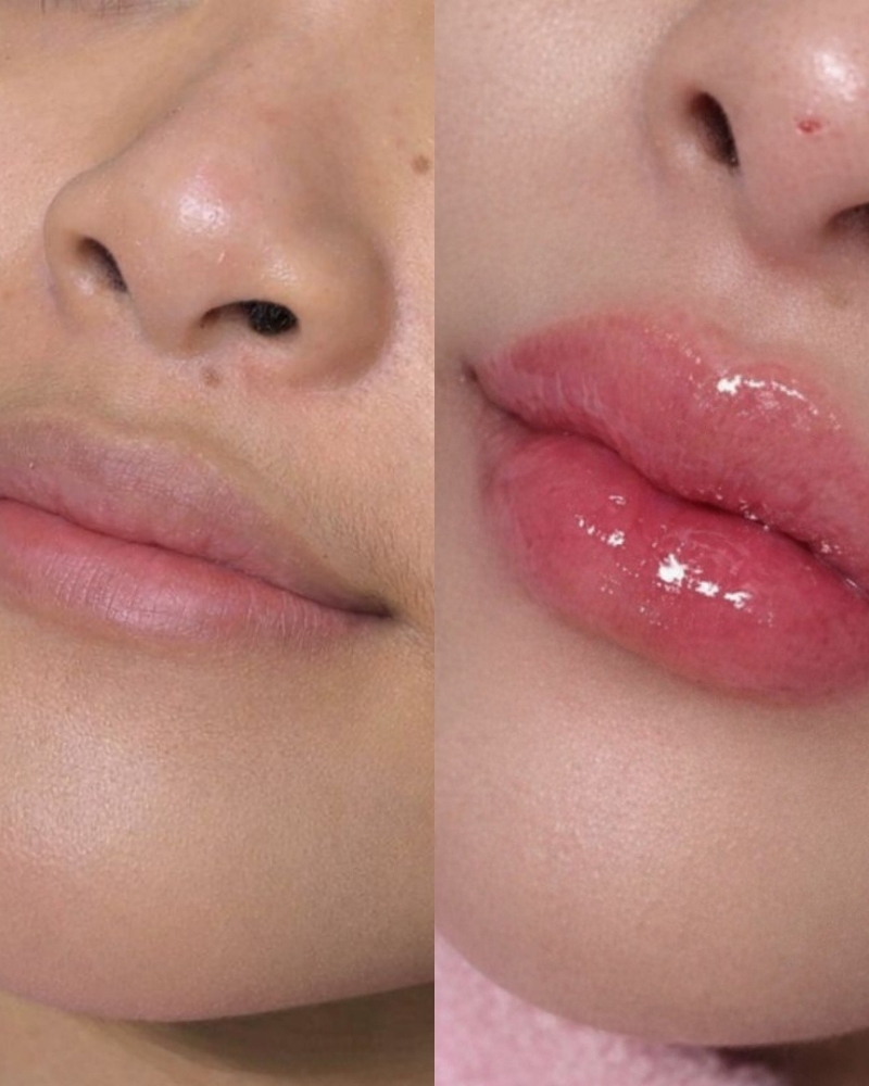 Before after Doux Lips Filler Qiandra Clinic
