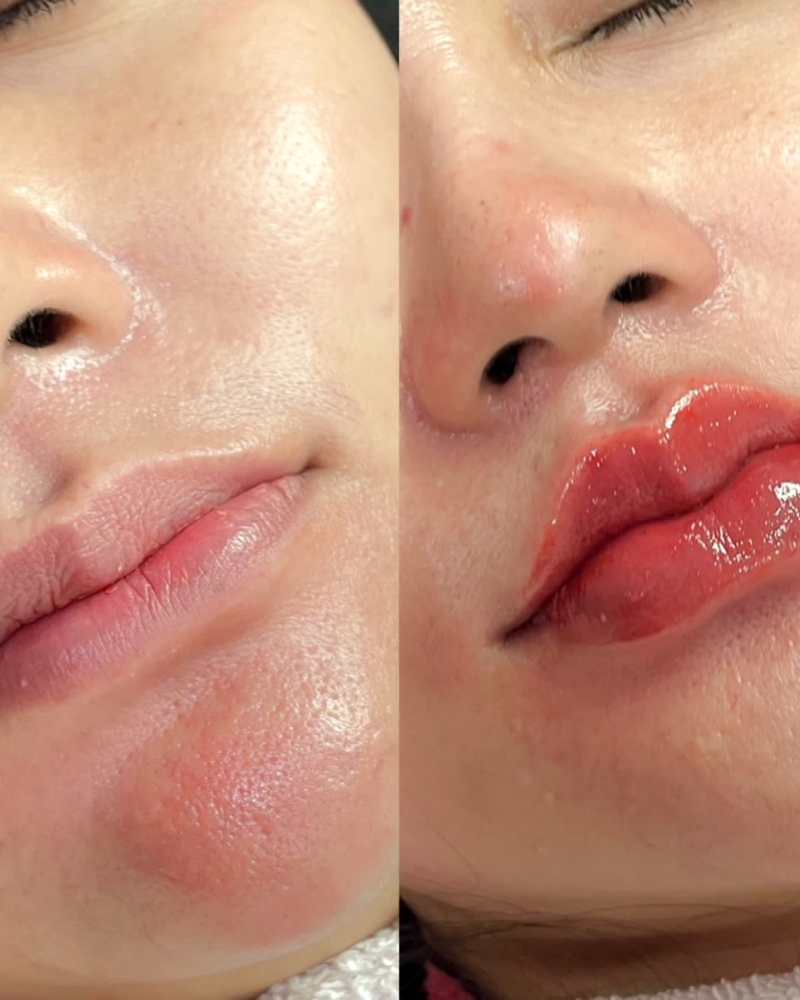 Before after Filler Bibir Qiandra Clinic