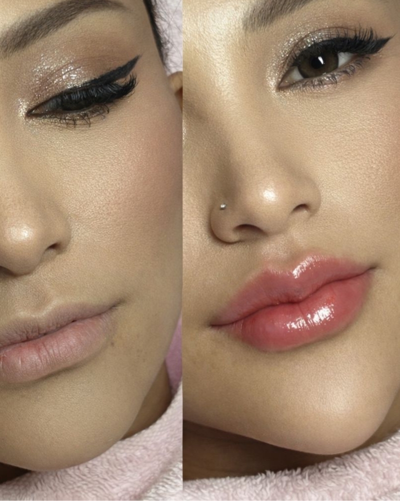 Before after Filler Dagu Qiandra Clinic