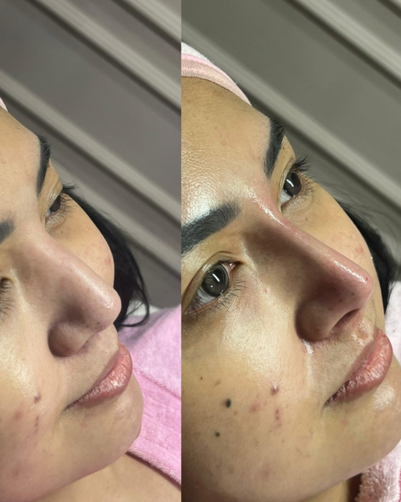 Before after Hollywood High Nose Qiandra Clinic