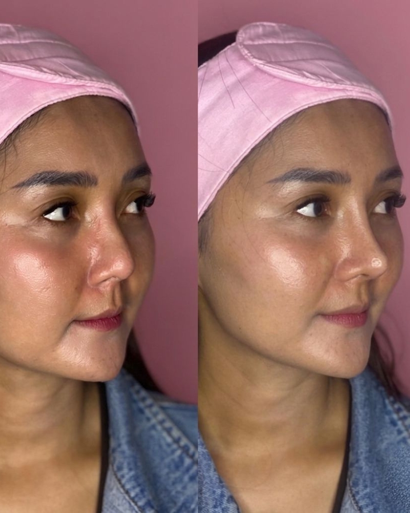 Before after Hollywood High Nose Qiandra Clinic