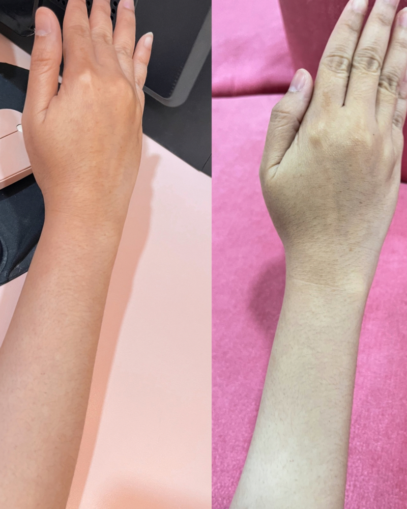 Before after Infus Whitening Qiandra Clinic