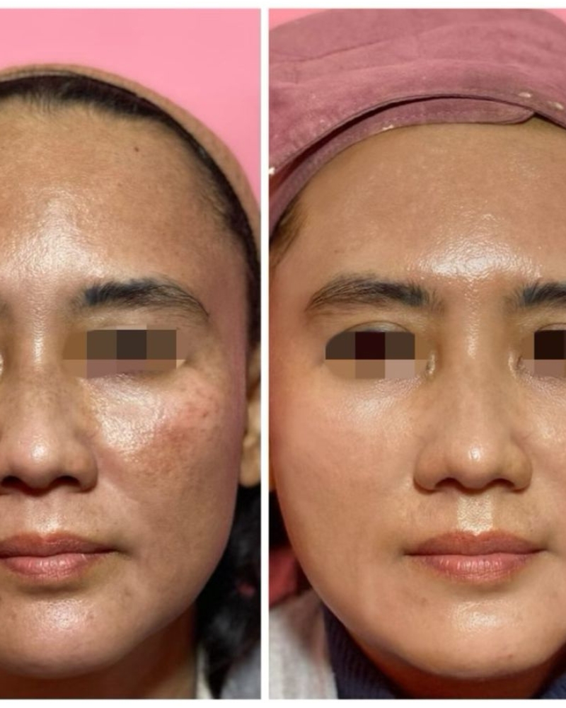 Before after Treatment Melasma Qiandra Clinic