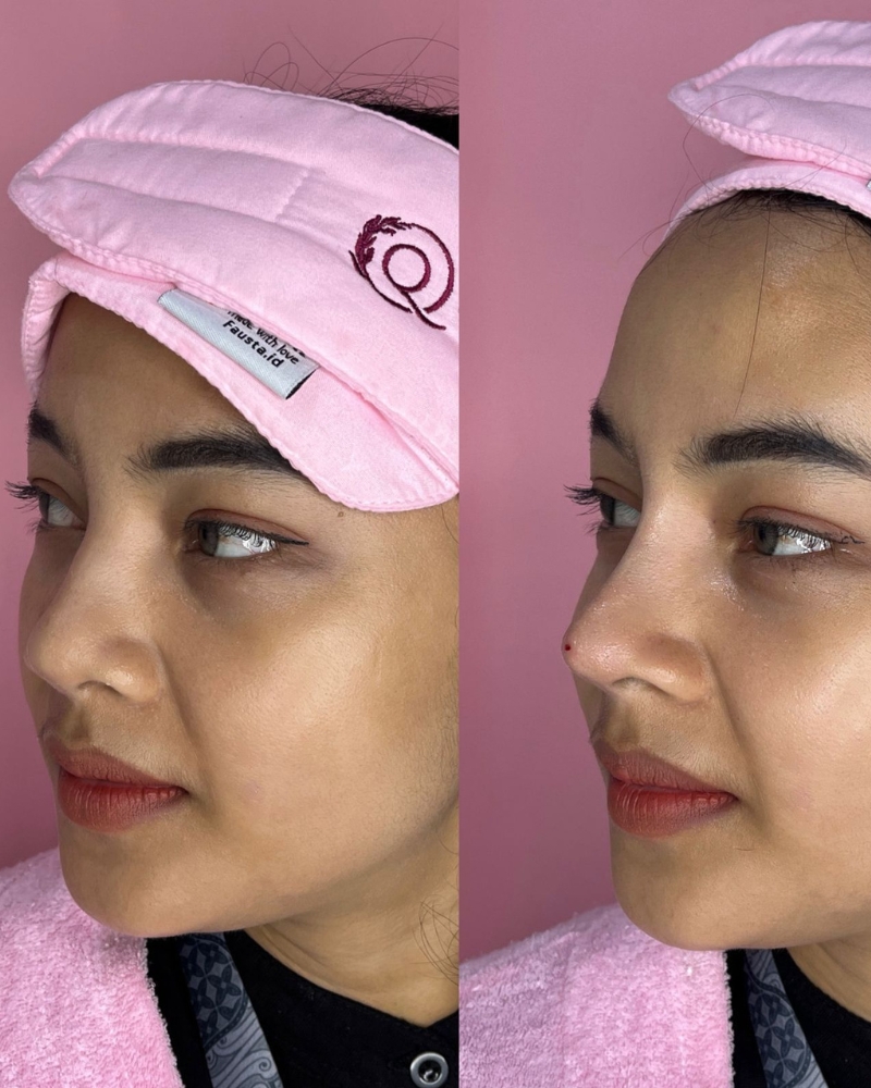 Before after New Perfect Nose Shape Qiandra Clinic