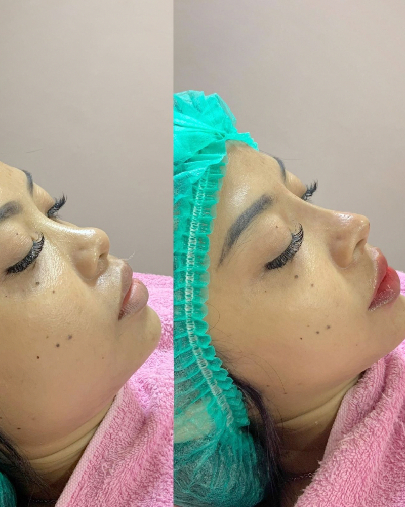Before after Paket Cantik Qiandra Clinic