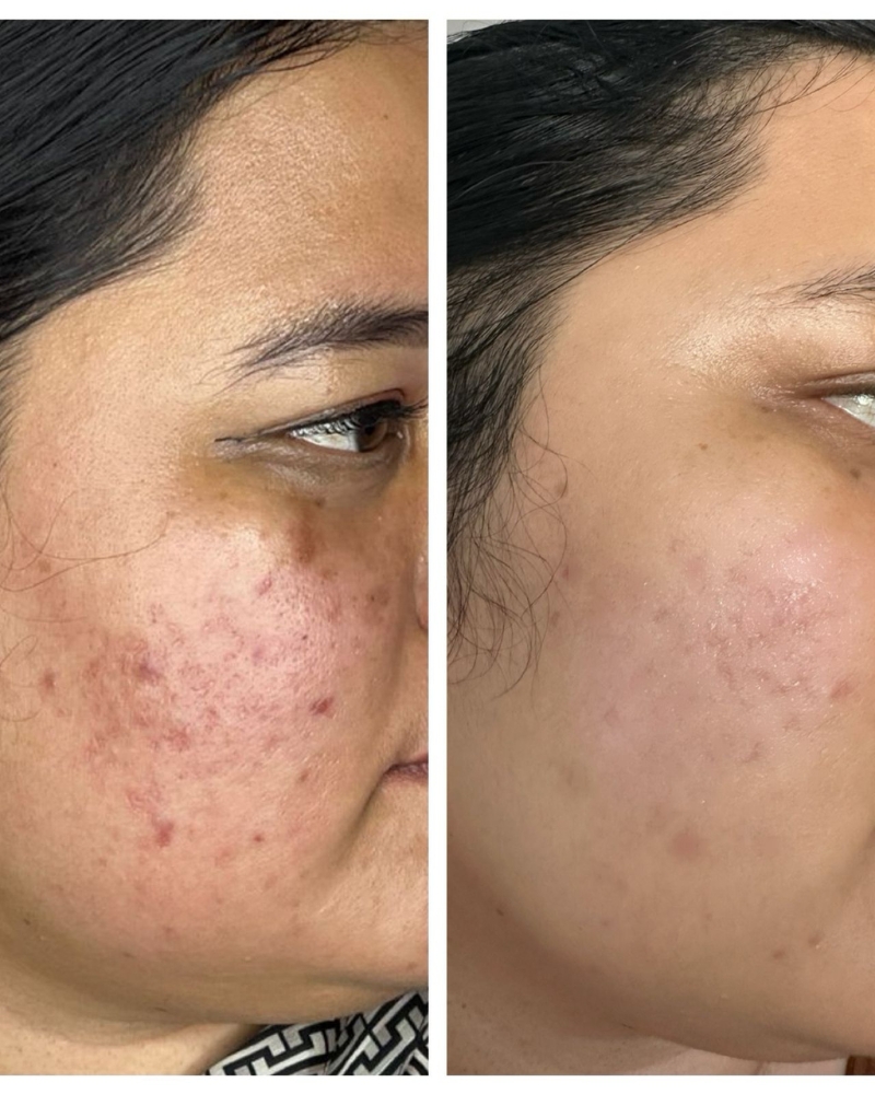 Before after Acne Scar Qiandra Clinic