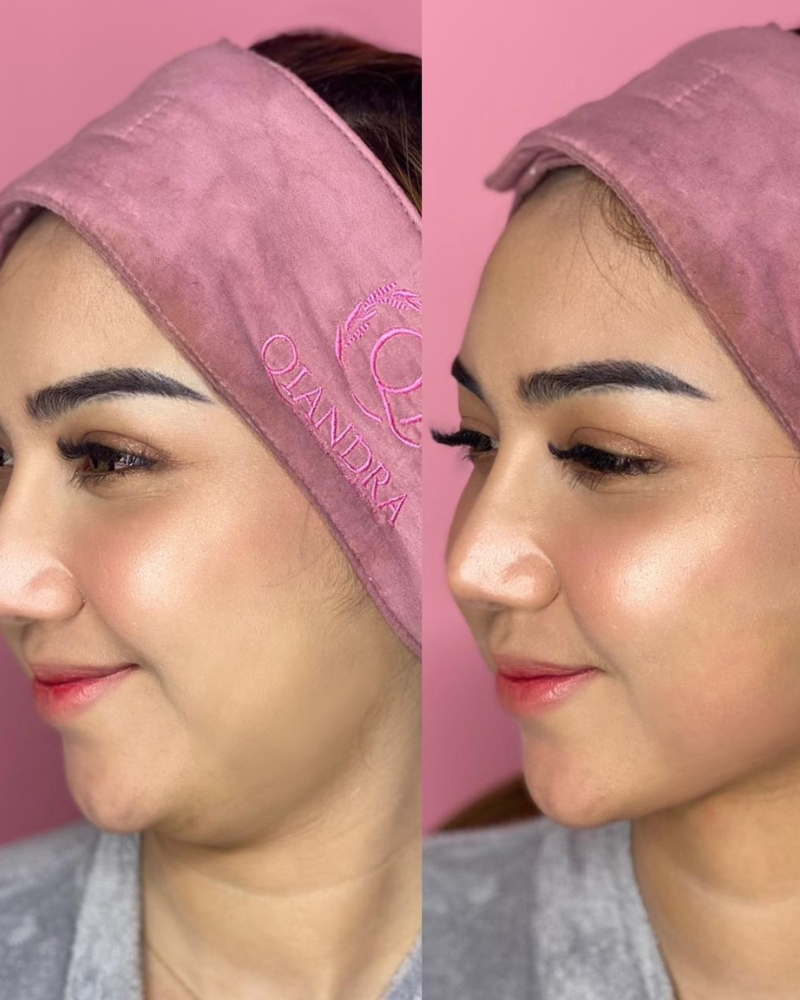 Before after Royal Fat Killer Qiandra Clinic