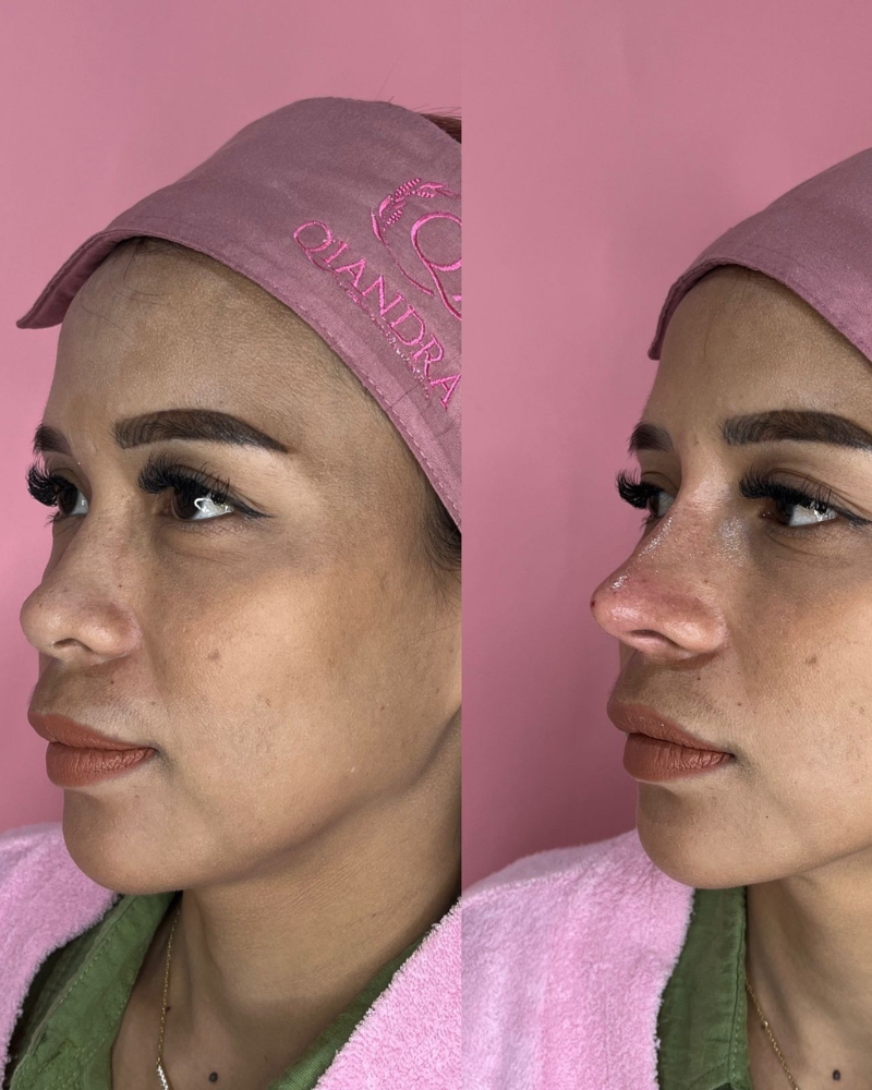 Before after Semi Implant Qiandra Clinic