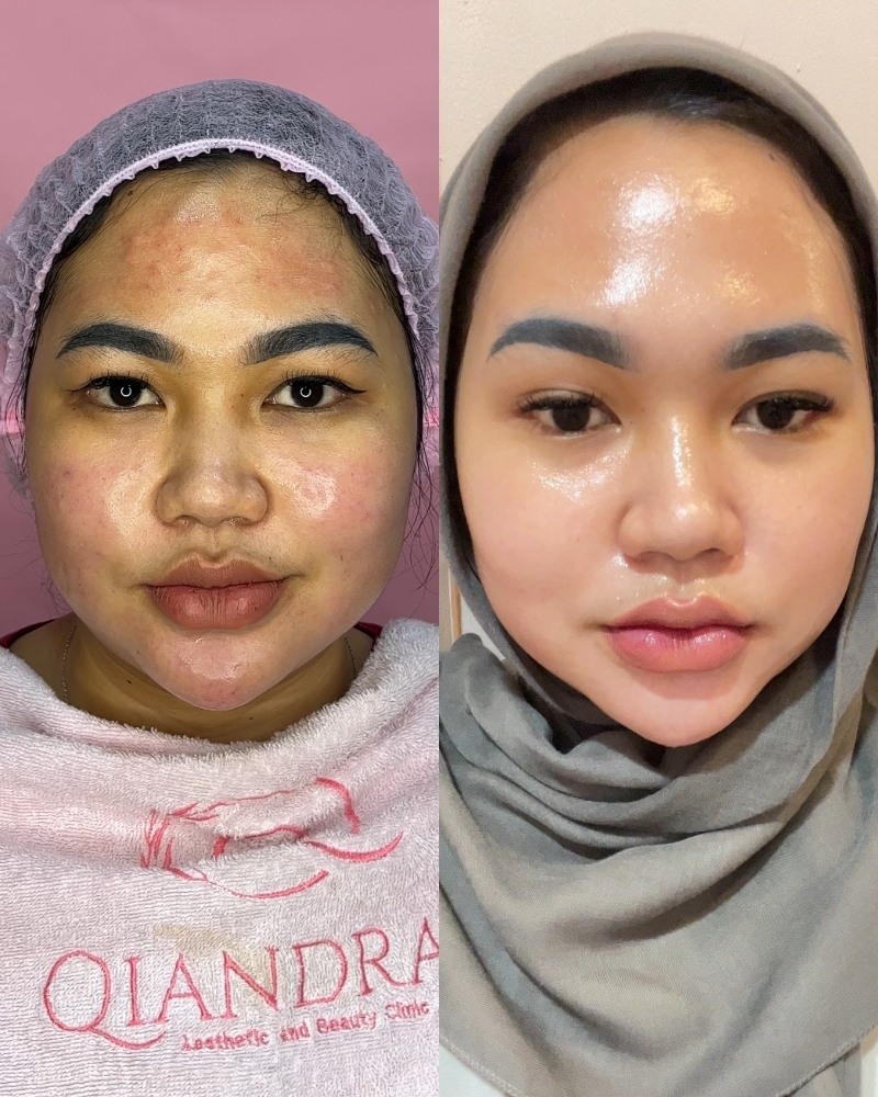 Before after Skinbooster Qiandra Clinic