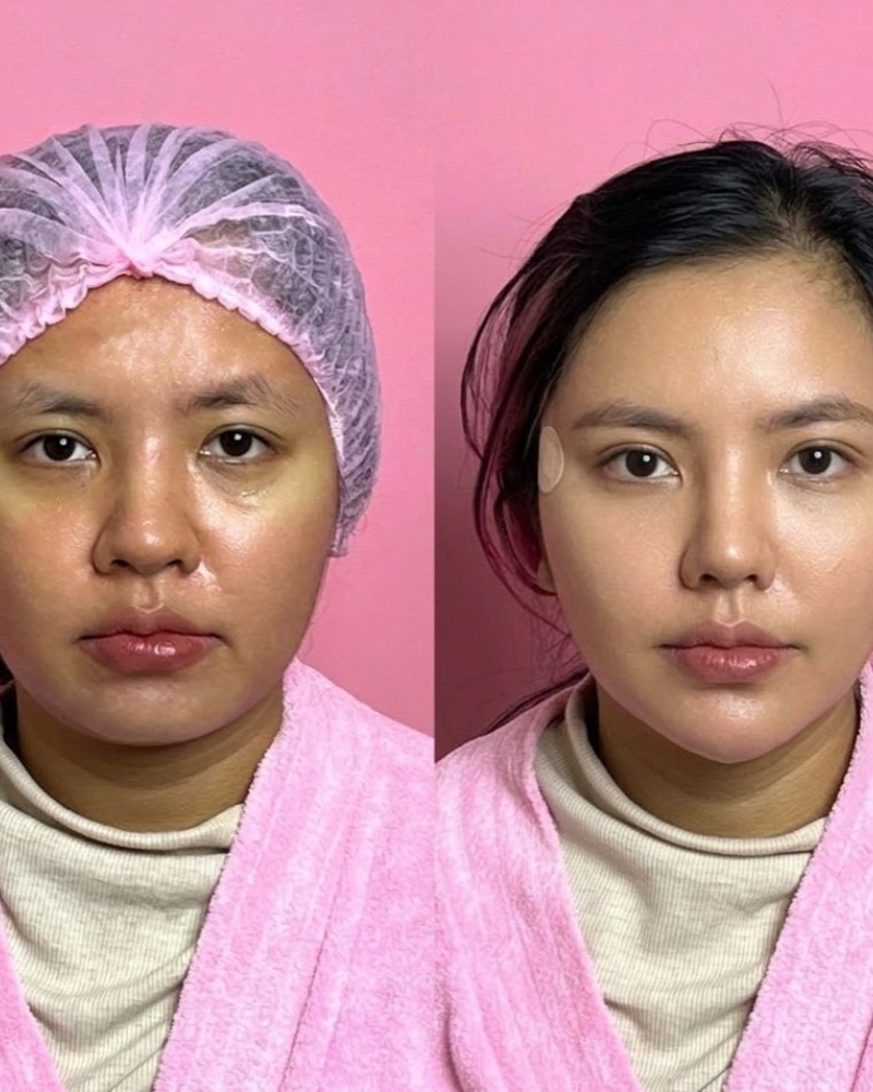 Before after Benang Croquis Qiandra Clinic