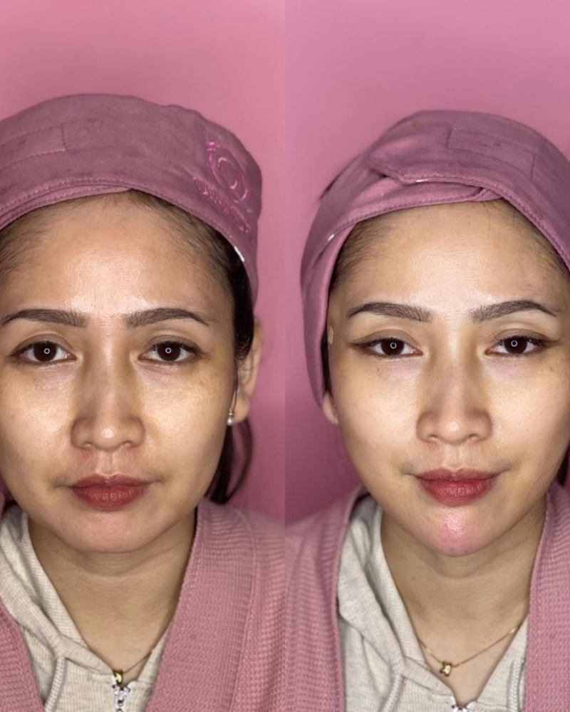 Before after Benang VXIL Qiandra Clinic