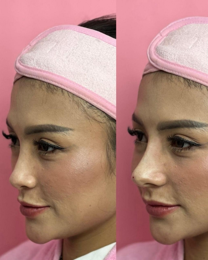 Before after New Tinkerbell Nose Qiandra Clinic